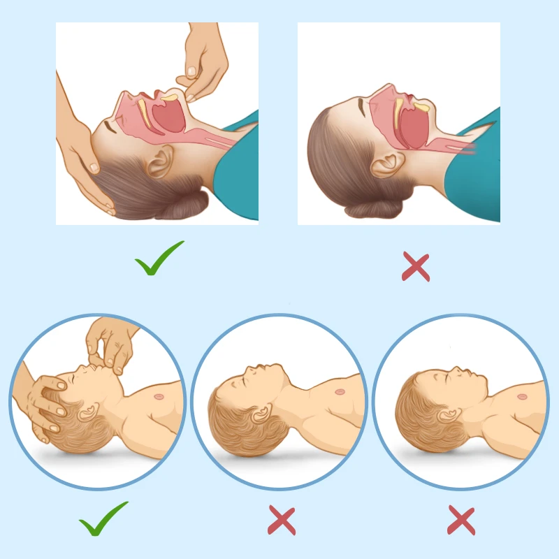 An open airway with a proper head tilt and chin lift prevents the tongue from obstructing the airway